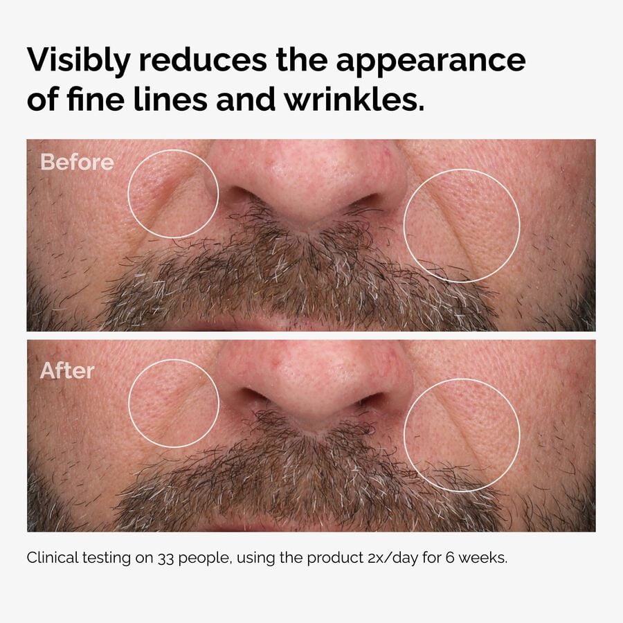 Before and After showing how 100% Fermented Rose Hip Seed Oil reduces fine lines and wrinkles