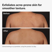 Before and After images showing a person's back. The 'Before' image displays body acne and uneven texture, while the 'After' image shows visibly smoother, clearer skin after using the product.