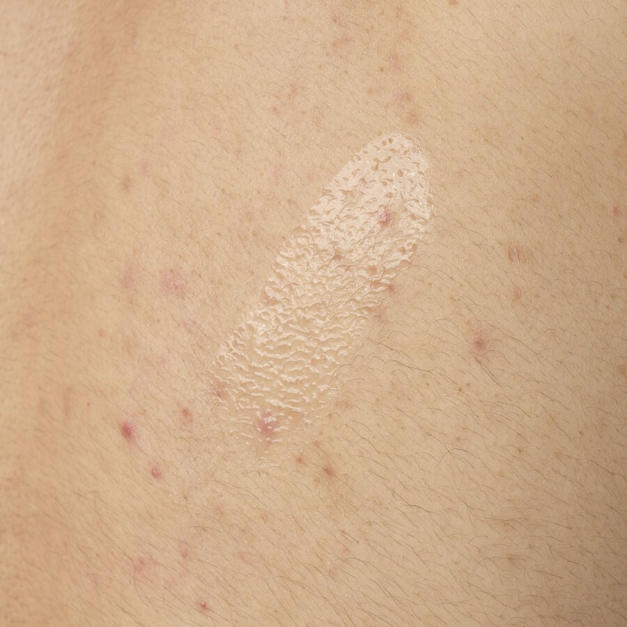 Close-up texture shot of The Ordinary Salicylic Acid 0.5% Body Serum. The clear, lightweight gel is shown applied directly to skin with some visible body acne, demonstrating its consistency.