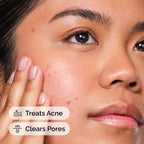Model application of Salicylic Acid 2% Solution